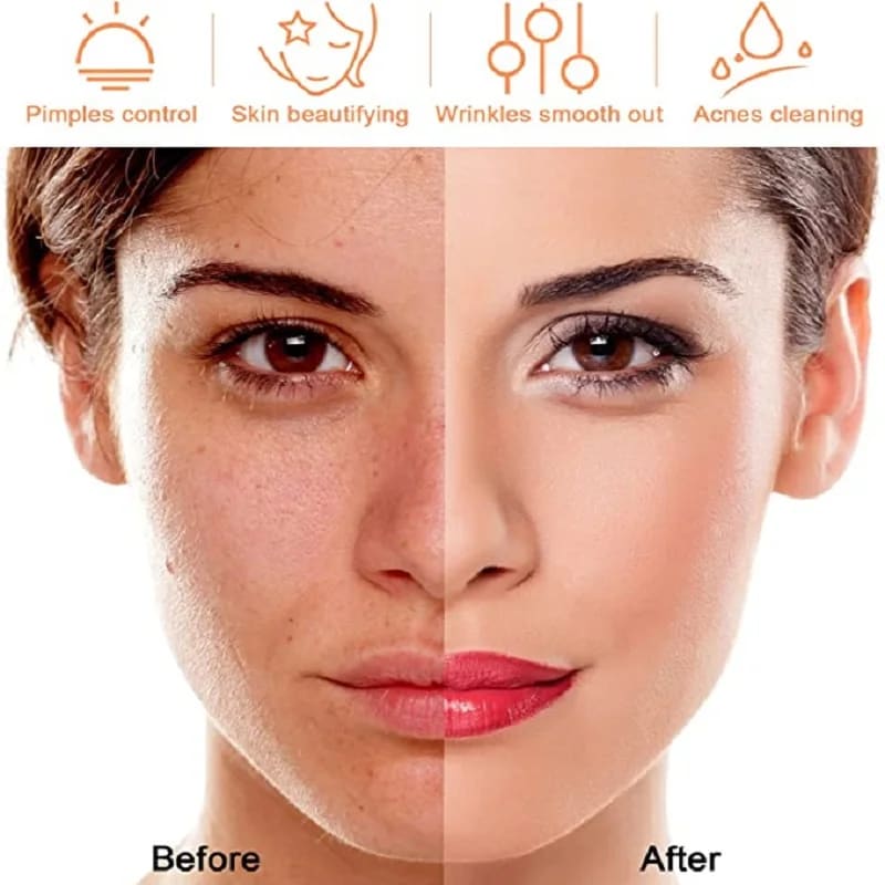 ALTA FRECUENCIA PORTÁTIL FACIAL, CABELLO CUERPO 4 ELECTRODOS